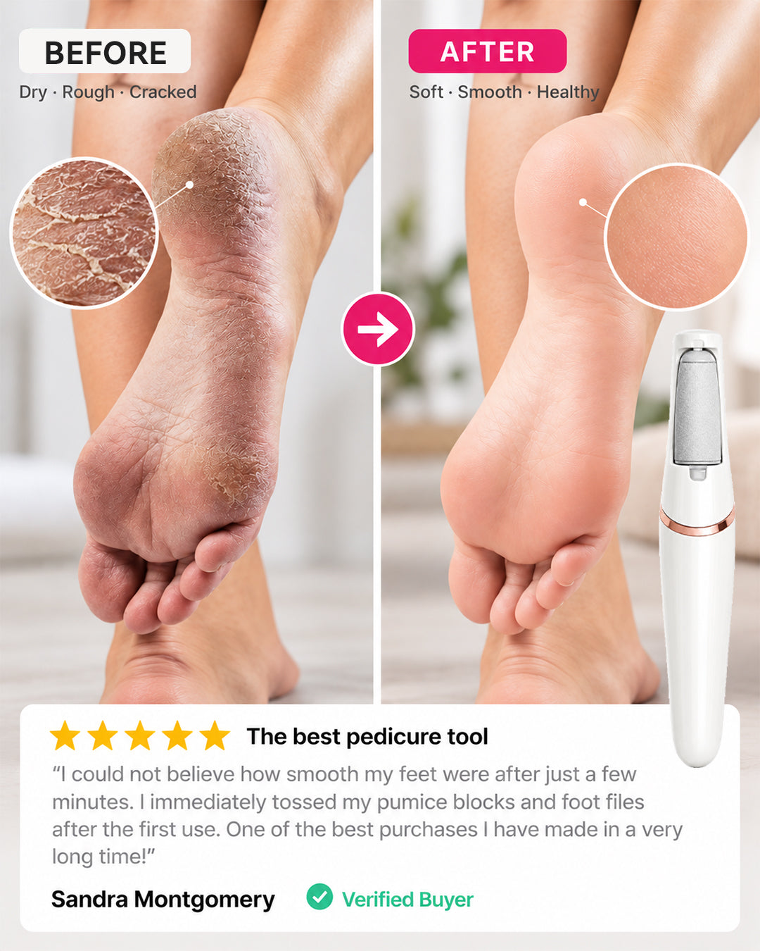 Jynvre Pedicure Callus Silk 3 Pro